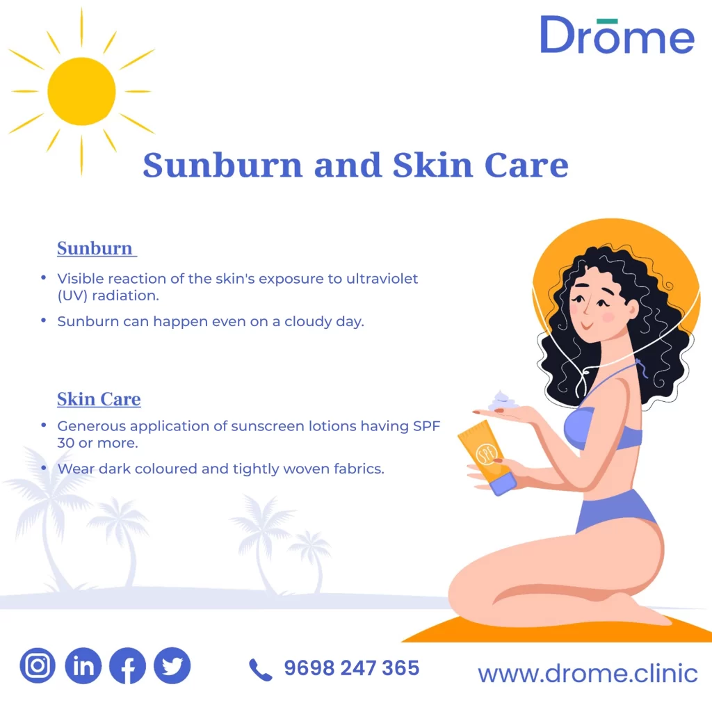 Sunburn-and-skincare