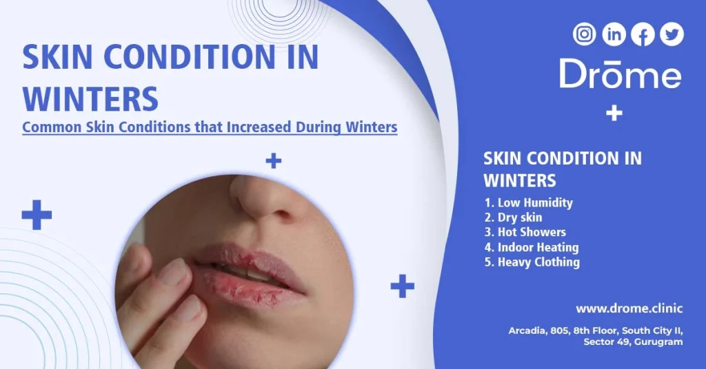 Skin-Condition-in-Winters