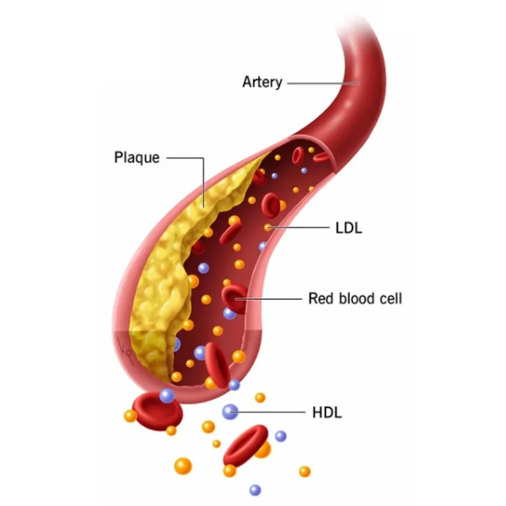 cholesterol-plaque