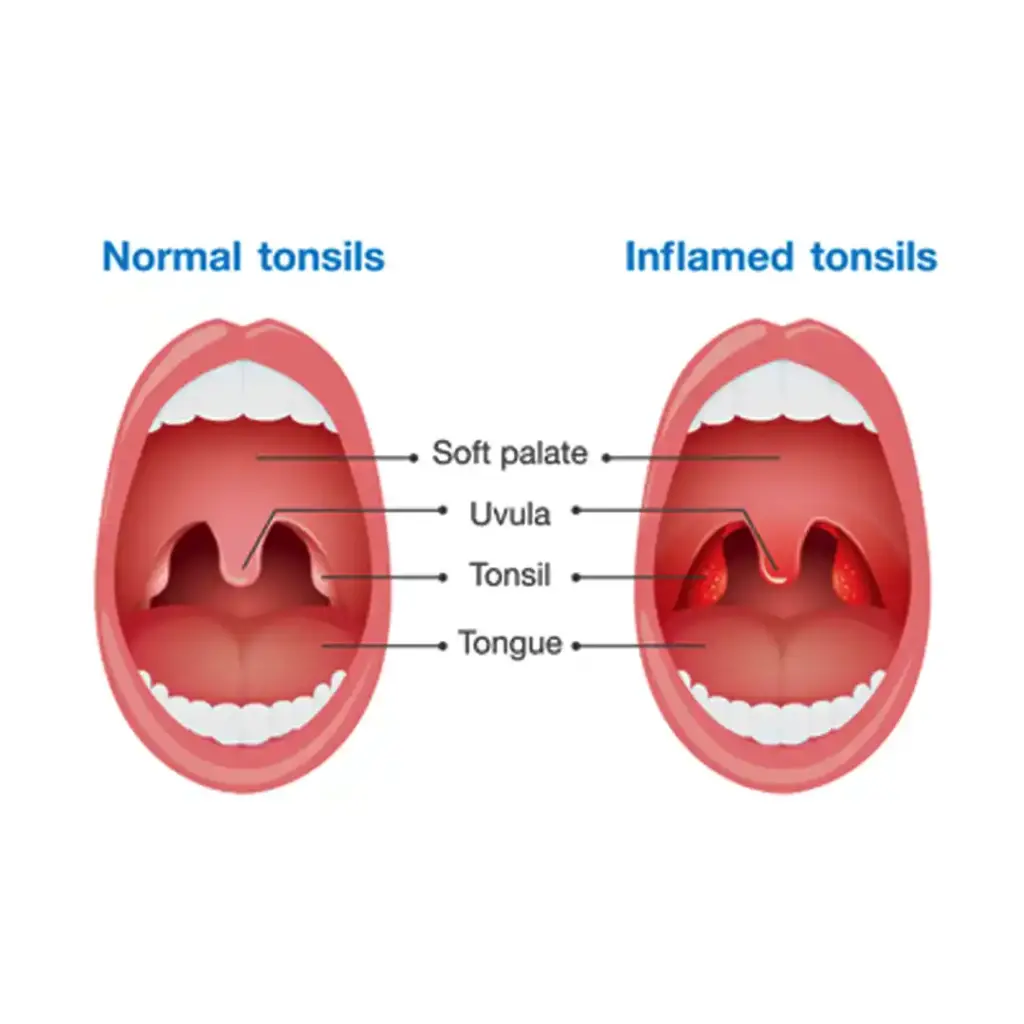 Tonsillitis Causes Symptoms And Effective Treatments