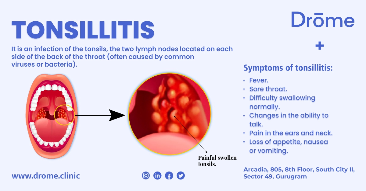 Tonsillitis: Causes, Symptoms, and Effective Treatments