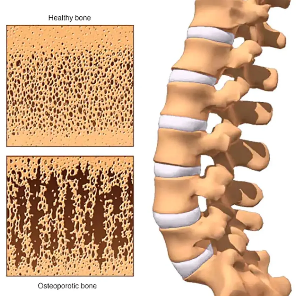 Osteoporosis-symptoms-prevention