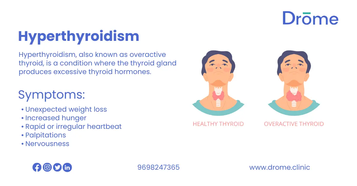 Hyperthyroidism – Causes, Symptoms & Treatment