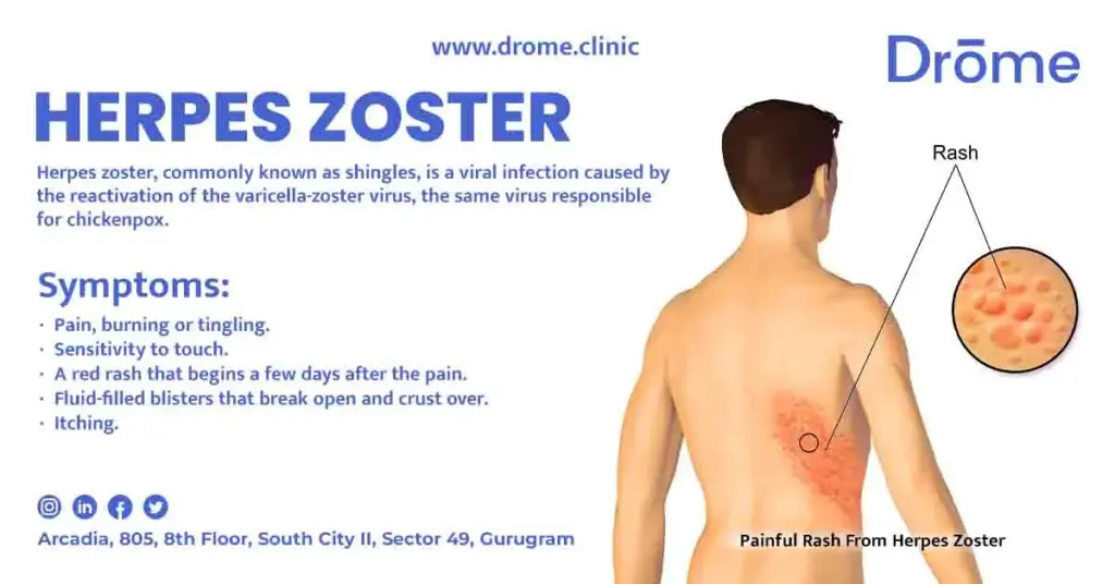 Herpes-Zoster